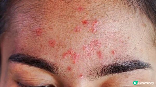 【皮膚管理】臉上不同位置長痘代表著什麽？快來看懂你的肌膚發出的信號！