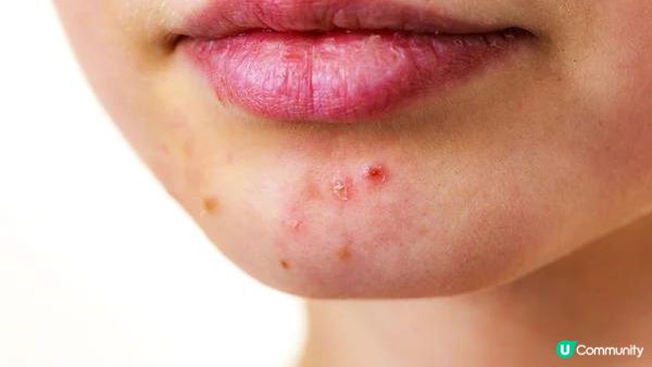 【皮膚管理】臉上不同位置長痘代表著什麽？快來看懂你的肌膚發出的信號！