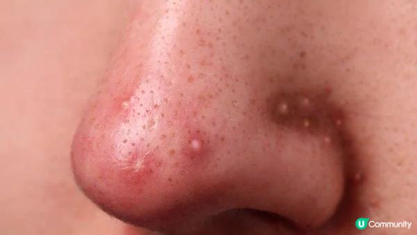 【皮膚管理】臉上不同位置長痘代表著什麽？快來看懂你的肌膚發出的信號！