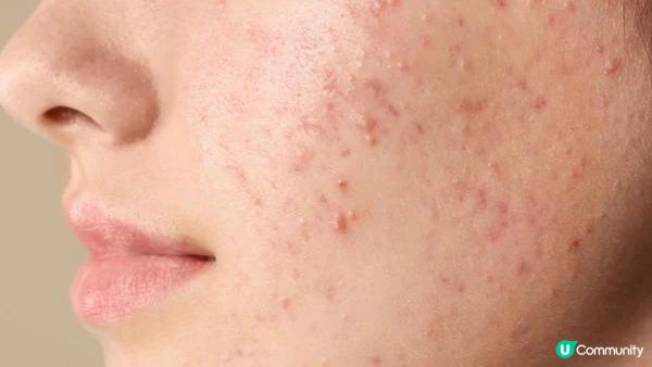 【皮膚管理】臉上不同位置長痘代表著什麽？快來看懂你的肌膚發出的信號！