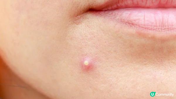 【皮膚管理】臉上不同位置長痘代表著什麽？快來看懂你的肌膚發出的信號！