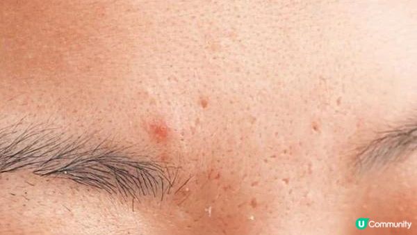【皮膚管理】臉上不同位置長痘代表著什麽？快來看懂你的肌膚發出的信號！