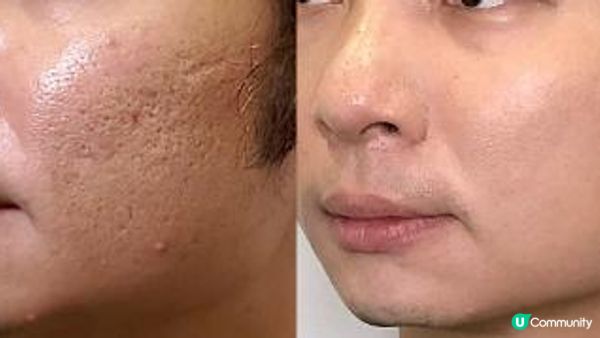 畀美容院黑店呃超過十萬 曾經覺得凹凸洞會跟一世