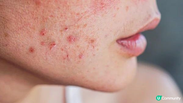 荷爾蒙失調的五大症狀！4招教你預防【荷爾蒙失調】