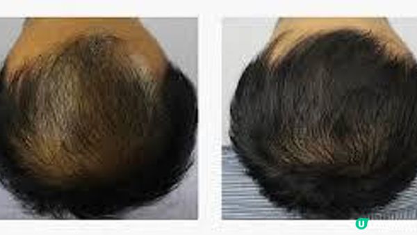 頭油太多導致脂溢性脫髮！頭皮護理與活髮救星：OASIS & Perfect Men 哪家更能在短時間內穩定頭皮狀態+生髮活髮？男士分享親測體驗，這家性價比出奇地高！