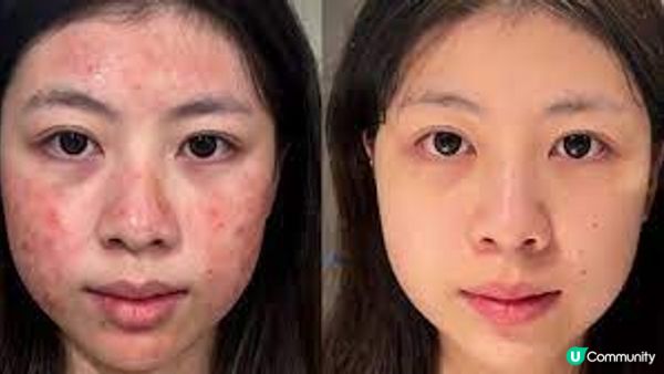 🤔【New Beauty 好唔好？暗瘡療程體驗】你問我答！