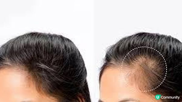 生髮療程比一比：Hair Forest RGA活髮療程 VS Perfect Hair F8 生髮療程，哪家增髮技術更強？M字額女生分享親測心得，這款無痛無創還安全有效！