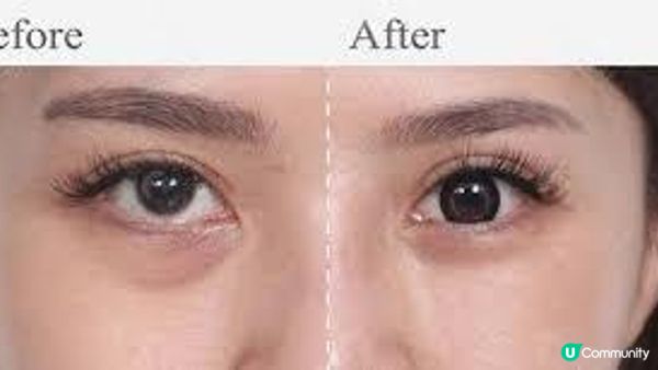 無痛無創去眼袋是癡人說夢？可夢想成真的2款非侵入性醫美專利技術：BMF VS New Beauty，哪家性價比更高？短期內剷除惱人眼袋並不無可能！