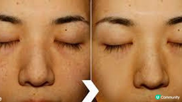 醫美光療容易踩雷？分享2款無痛無創激光祛斑嫩膚療程：You Beauty & New Beauty！雖然兩家勢均力敵，但實測這款更能在短期內見效，輕鬆GET無暇膚質！