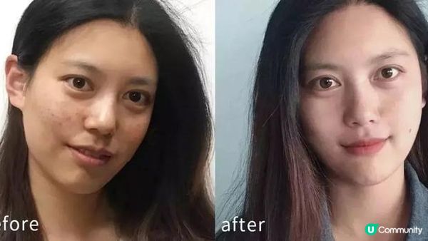 名人代言好物分享：BMF & New Beauty 超神醫美祛斑嫩膚療程，哪家性價比更高？小資女親測後表示這家面面俱到，療效難以置信地好！