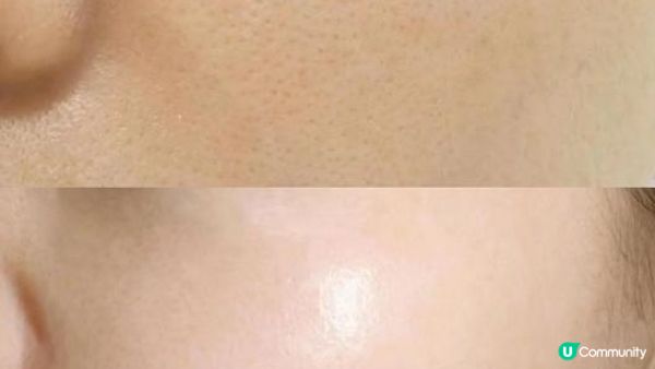 我俾Vivian 肥肥人燒咗，去咗打Rejuran麗珠蘭，效果真係……