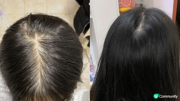 Perfect Hair 好唔好？我嘅 Perfect Hair F8 生髮療程親身體驗：打破「黑店」誤解