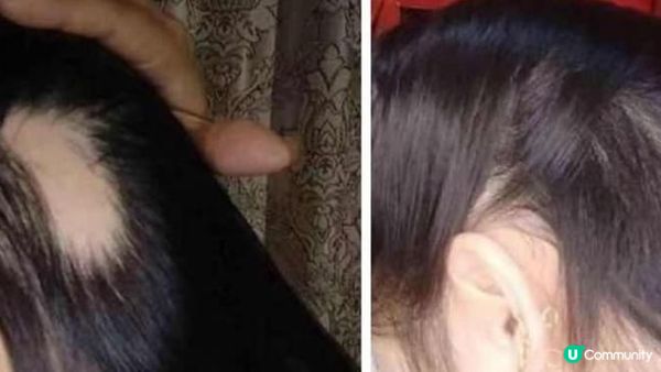 根治斑禿得靠醫美！分享2款活髮方案：DNA Hair Lab 基恩活髮 & Perfect Hair，2家技術都不容小覷，實測這款真能在短時間內讓髮量暴漲！