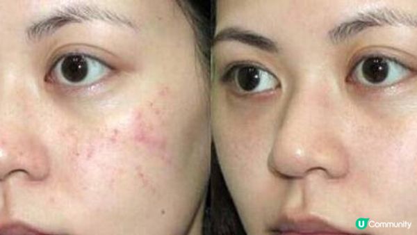 皮秒祛斑嫩膚100%無痛無創？為辨真假小資女親測2款平價療程：You Beauty & New Beauty，哪一款能在更短時間內K.O色斑凹凸洞？