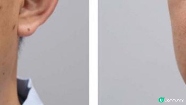 2款男士祛斑嫩膚方案推介：MSC VS Perfect Men 激光光療技術哪家更勝一籌？實測這家不僅零副作用，無需修復期還快速見效，輕鬆剷除惱人色斑！