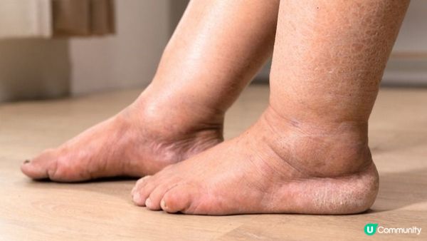 【瘦腿方法】3種粗腿型，有一種特別難減，你屬於那一種？