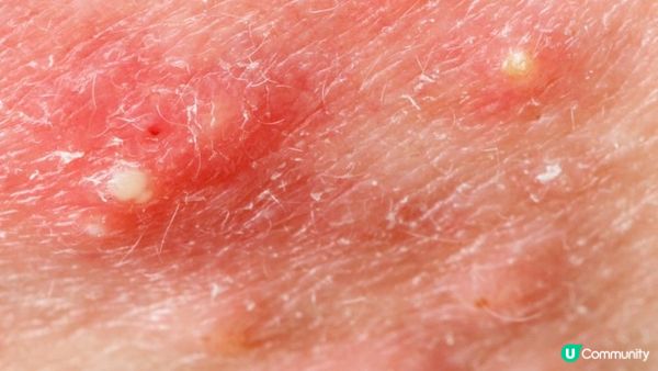 擠暗瘡傷害大？如何正確處理暗瘡？各類暗瘡的最佳處理方法!