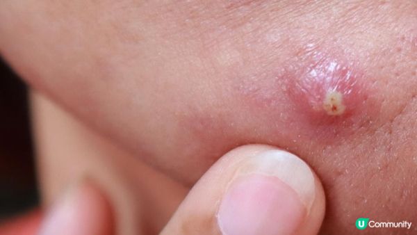 擠暗瘡傷害大？如何正確處理暗瘡？各類暗瘡的最佳處理方法!