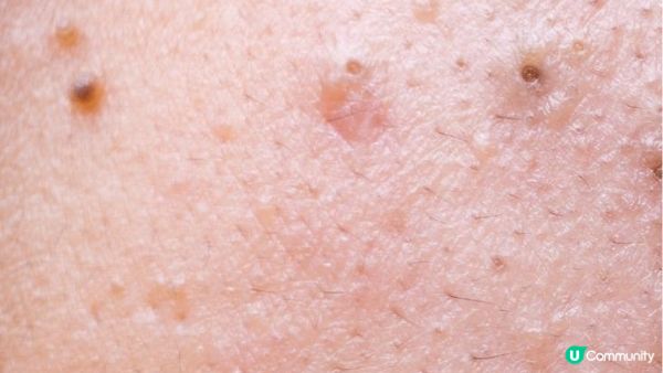 擠暗瘡傷害大？如何正確處理暗瘡？各類暗瘡的最佳處理方法!