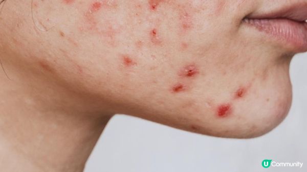 擠暗瘡傷害大？如何正確處理暗瘡？各類暗瘡的最佳處理方法!