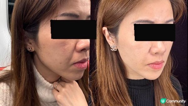 38歲～第一次打！膠原針！