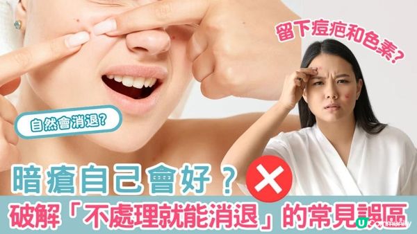 暗瘡自己會好？破解「不處理就能消退」的常見誤區