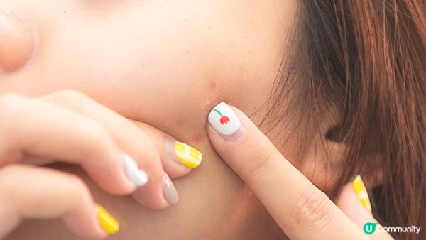 暗瘡自己會好？破解「不處理就能消退」的常見誤區