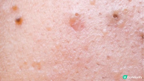 如何分辨黑頭和白頭粉刺？專家揭示最不推薦的兩種清除方式