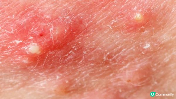 如何分辨黑頭和白頭粉刺？專家揭示最不推薦的兩種清除方式