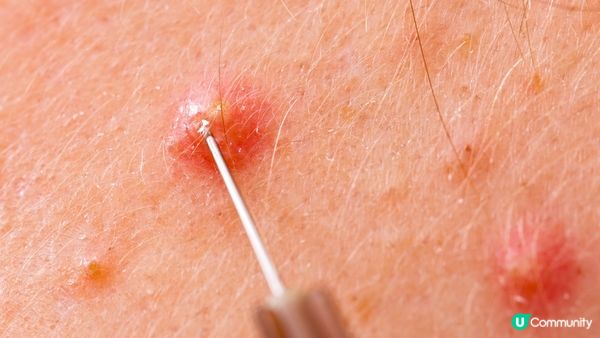 如何分辨黑頭和白頭粉刺？專家揭示最不推薦的兩種清除方式