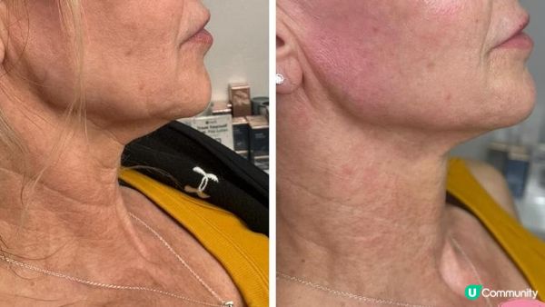 30+必做療程？凍齡逆齡神器Sylfirm X矽谷電波大解構：Sylfirm X原理？效果？副作用？附大量真人實證Sylfirm X效果圖！