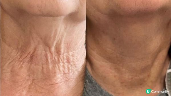 30+必做療程？凍齡逆齡神器Sylfirm X矽谷電波大解構：Sylfirm X原理？效果？副作用？附大量真人實證Sylfirm X效果圖！