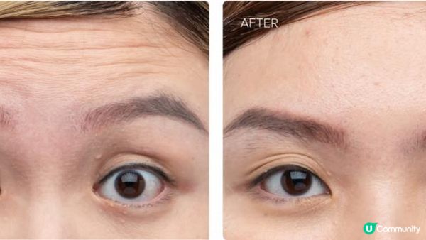 肉毒桿菌懶人包！新一代肉毒【XEOMIN】VS肉毒元祖【BOTOX】：分別？效果？價錢？