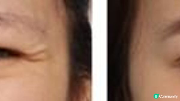 肉毒桿菌懶人包！新一代肉毒【XEOMIN】VS肉毒元祖【BOTOX】：分別？效果？價錢？