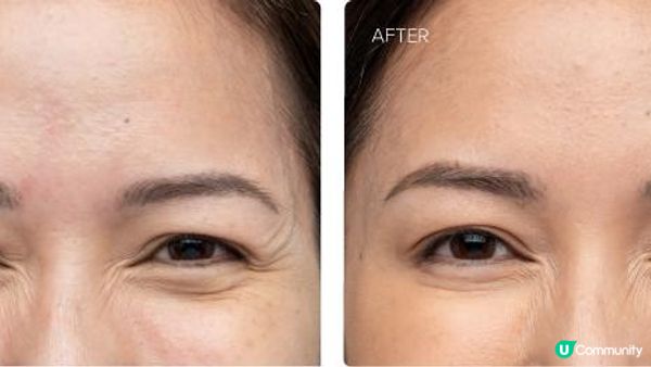肉毒桿菌懶人包！新一代肉毒【XEOMIN】VS肉毒元祖【BOTOX】：分別？效果？價錢？
