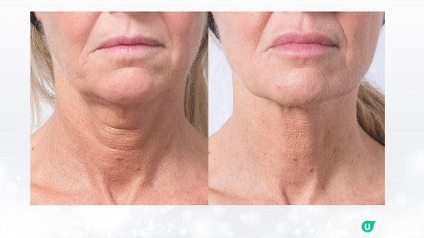 金秀賢37歲如同27歲？逆齡抗老神器：Profhilo逆時針功效！