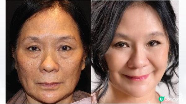 金秀賢37歲如同27歲？逆齡抗老神器：Profhilo逆時針功效！