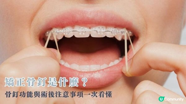 矯正骨釘是什麼？骨釘功能與術後注意事項一次看懂