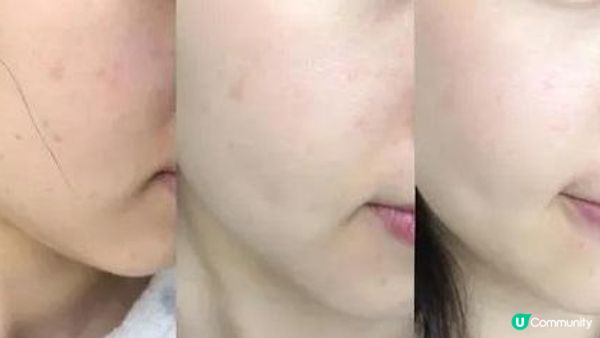 PICO有幾好？去斑迷思唔係人人都知！