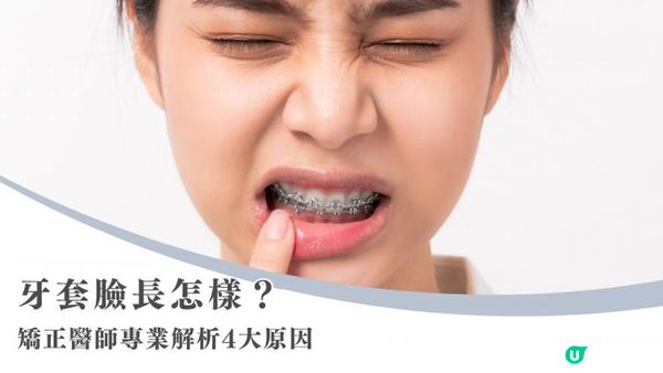 牙套戴久臉型會變嗎？矯正醫師解析 4 大關鍵原因
