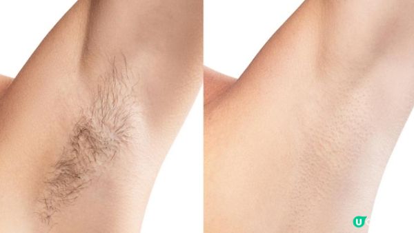 私密處與腋下除毛美白全攻略 告別暗沉異味打造清爽光滑肌！