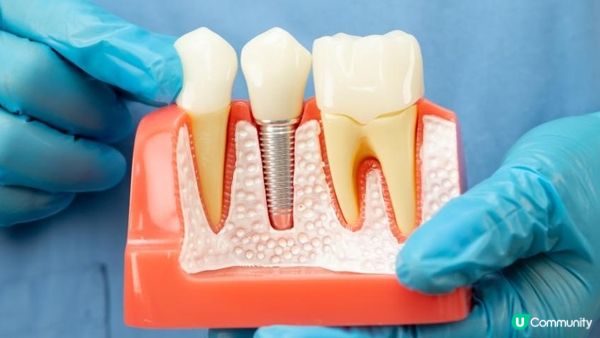 2026 植牙全攻略！解析價格、後遺症預防到成功案例，助您重拾自信笑容