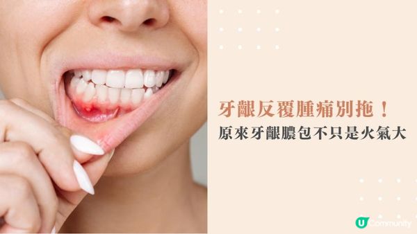 牙齦反覆腫痛別拖！原來牙齦膿包不只是火氣大