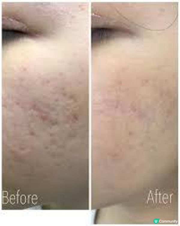 痘印肌親測體驗分享：同時去斑去凹凸洞並非癡人說夢！DR REBORN VS New Beauty 這款價廉物美，一次就見效！