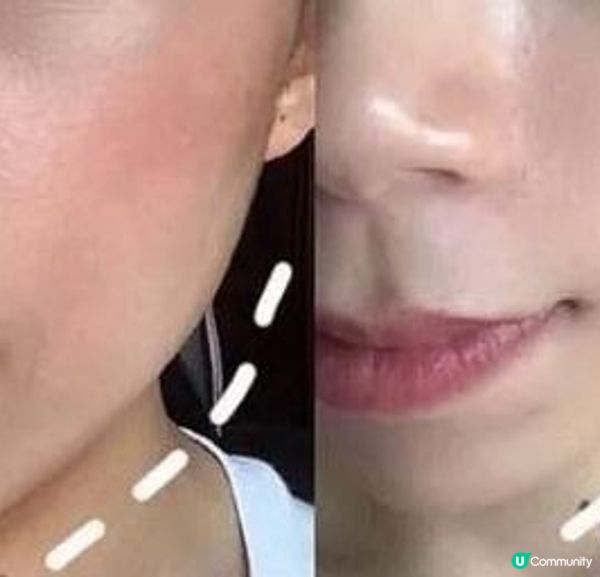 蘋果肌有下滑跡象……help! 同病者請進！