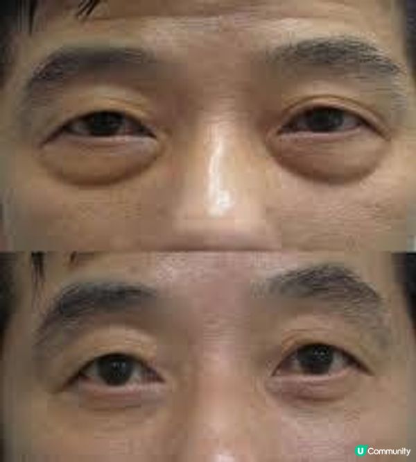 熊貓眼眼袋深怎麼破？男士無私分享2款去眼袋醫美療程：MANNER VS Perfect Men 究竟哪款更符合男生理想的性價比？這款能在短期內剷除容貌焦慮！