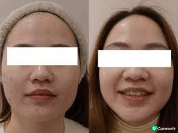 祛斑嫩膚、縮小毛孔靠醫美準沒錯！分享爆紅療程體驗：perFACE VS New Beauty，便宜一定無好貨嗎？究竟哪款能在短期內見效？