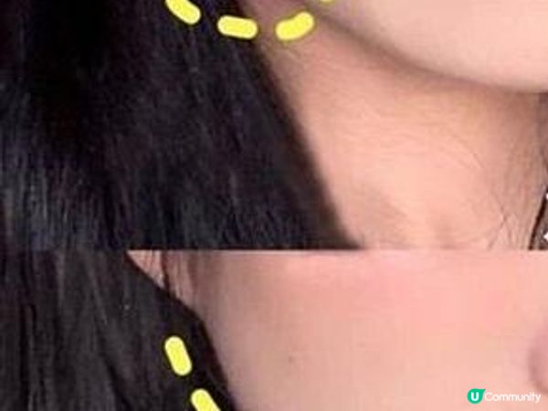 慎入！HIFU副作用!? 原來係咁架……