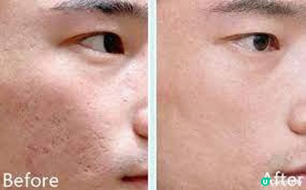 男人也能靠醫美輕鬆祛斑嫩膚！足以K.O色斑凹凸洞的2款熱門療程：DR REBORN VS Perfect Men，貴貨一定好，便宜無好貨？這款性價比比想像中更高！