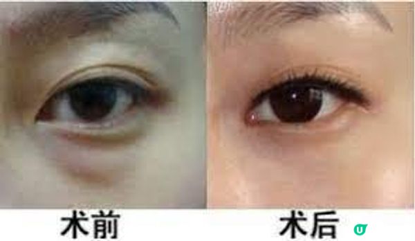 去眼袋淚溝一定要靠填充嗎？親測2種截然不同的眼周護理醫美服務：MEDILASE & Perfect Medical，這款更安全溫和，不像網民說的那麼可怕！